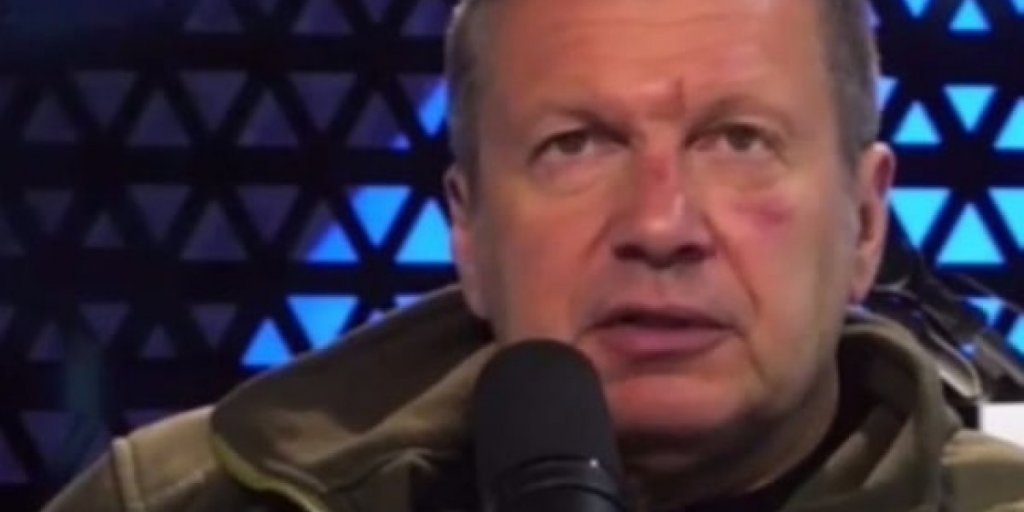 Пугачева – добрейший лютик: появилась новая версия появления синяков на лице у Соловьева